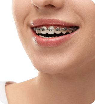 Invisalign