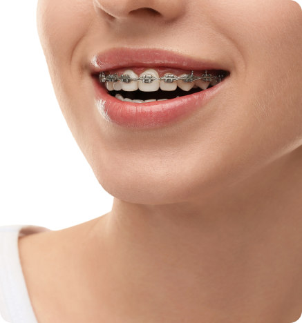 How Do Braces Work?